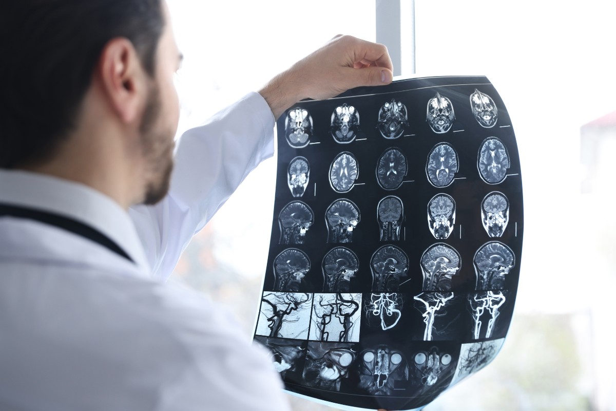 Proving Pain and Suffering After a Traumatic Brain Injury (TBIs)